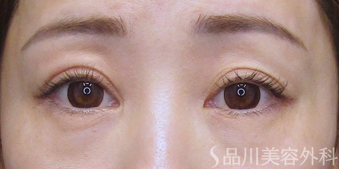 症例NO.75145のAFTER写真