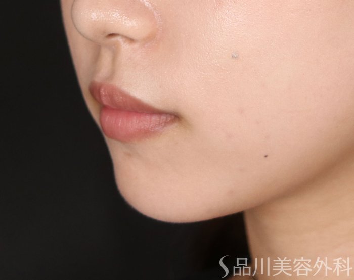 症例NO.74252のBEFORE写真