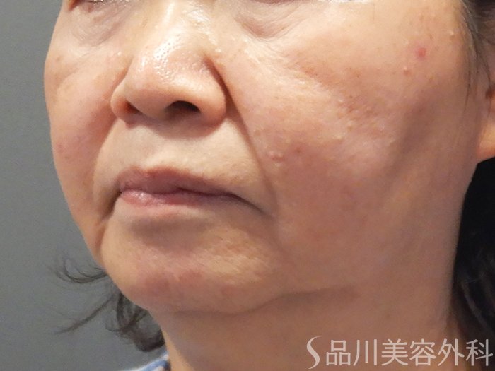 症例NO.72163のBEFORE写真