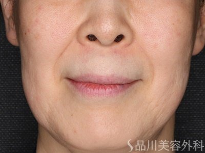 症例NO.75341のBEFORE写真