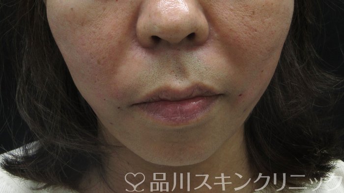 症例NO.70507のAFTER写真