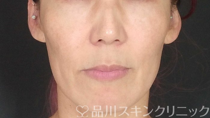 症例NO.72085のBEFORE写真