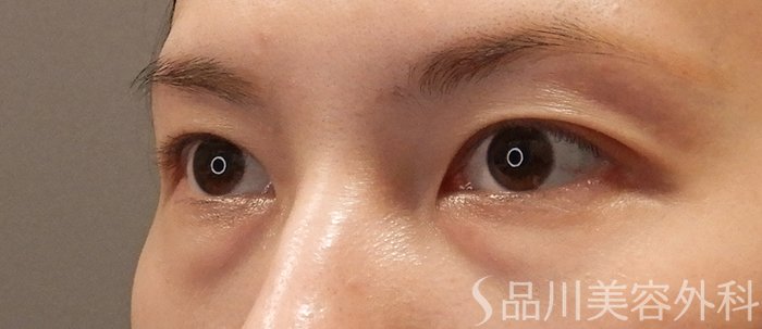 症例NO.71728のBEFORE写真