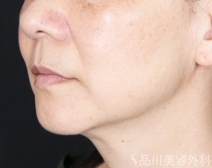 症例NO.71562のBEFORE写真
