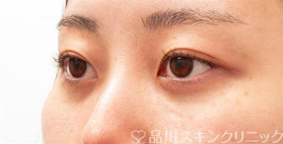 症例NO.53260のAFTER写真