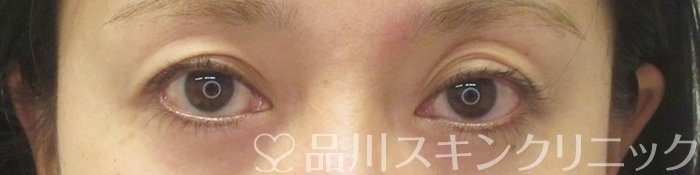症例NO.71091のBEFORE写真