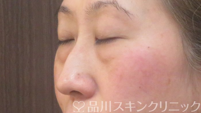 症例NO.72643のBEFORE写真