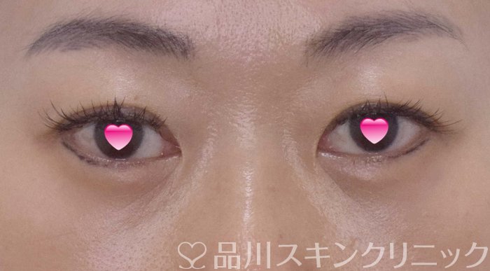 症例NO.65062のAFTER写真