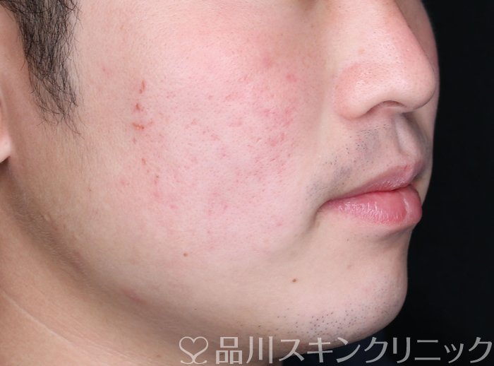 症例NO.70401のAFTER写真