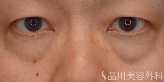 症例NO.64908のBEFORE写真