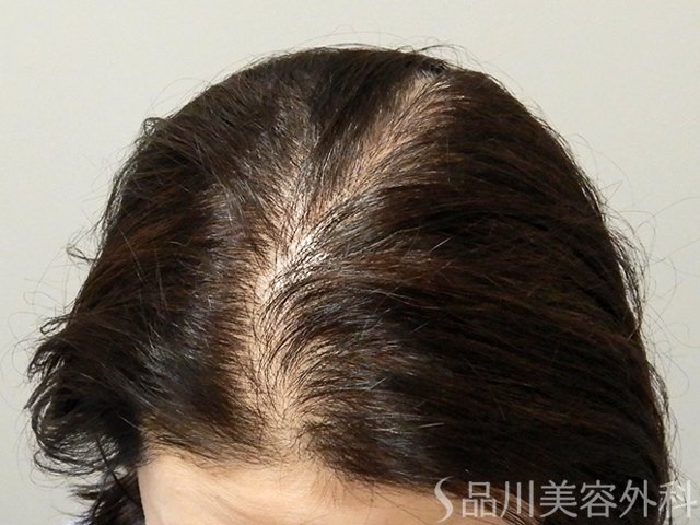 症例NO.69316のAFTER写真