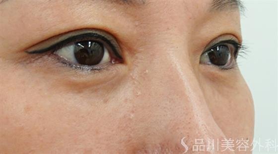 症例NO.46605のAFTER写真