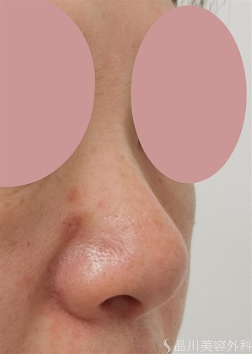 症例NO.27908のBEFORE写真