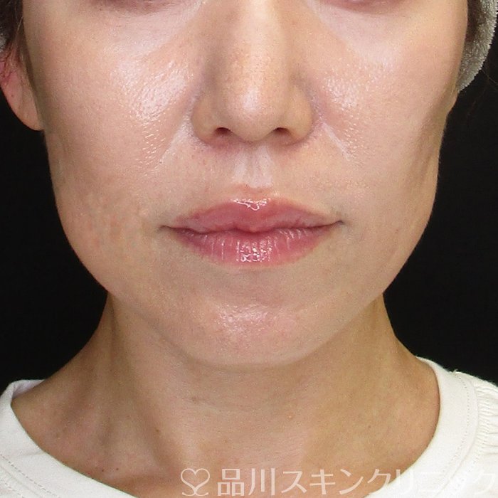 症例NO.67916のBEFORE写真