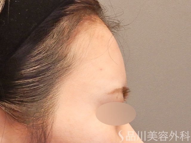 症例NO.72529のAFTER写真