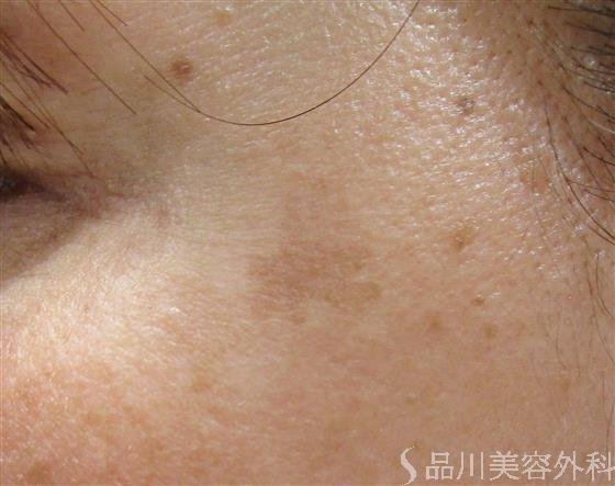 症例NO.53100のBEFORE写真