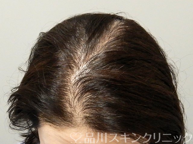 症例NO.69316のAFTER写真