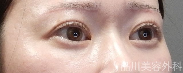 症例NO.74127のAFTER写真