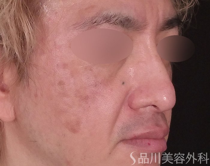 症例NO.72473のBEFORE写真