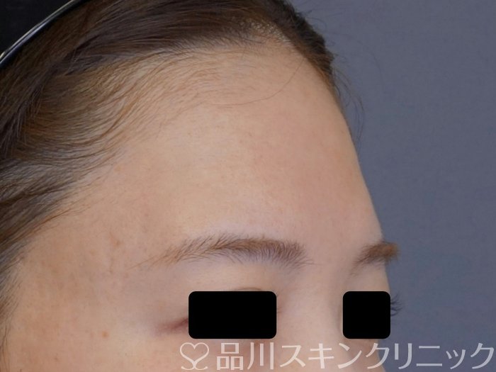 症例NO.74516のBEFORE写真