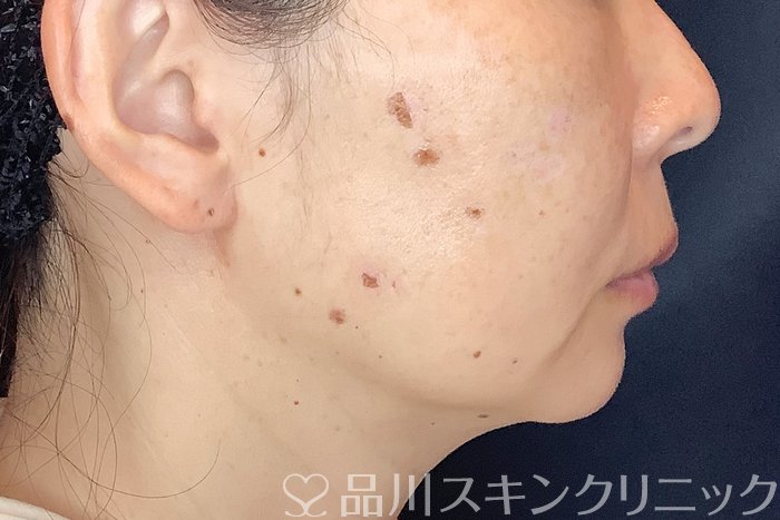 症例NO.70751のBEFORE写真