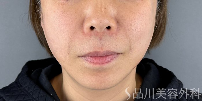 症例NO.69282のAFTER写真