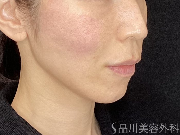 症例NO.72126のAFTER写真