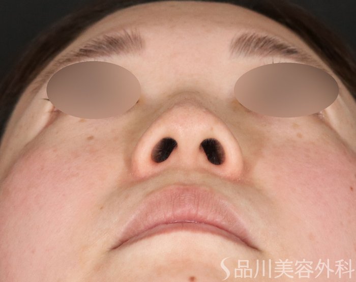 症例NO.72636のBEFORE写真