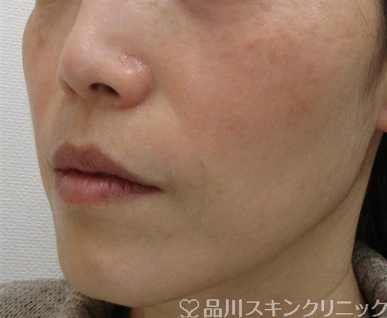 症例NO.41445のAFTER写真