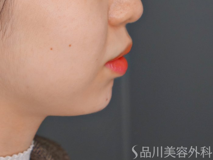 症例NO.69710のAFTER写真