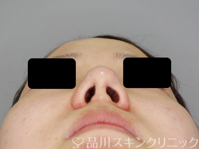 症例NO.73090のAFTER写真