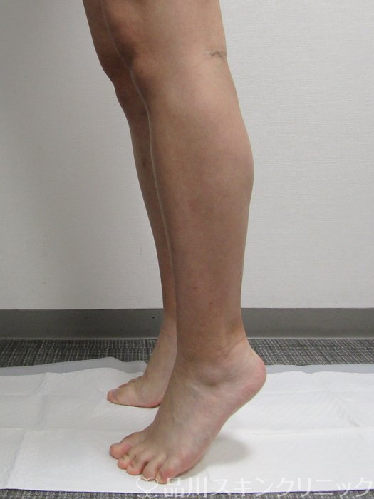 症例NO.75232のBEFORE写真