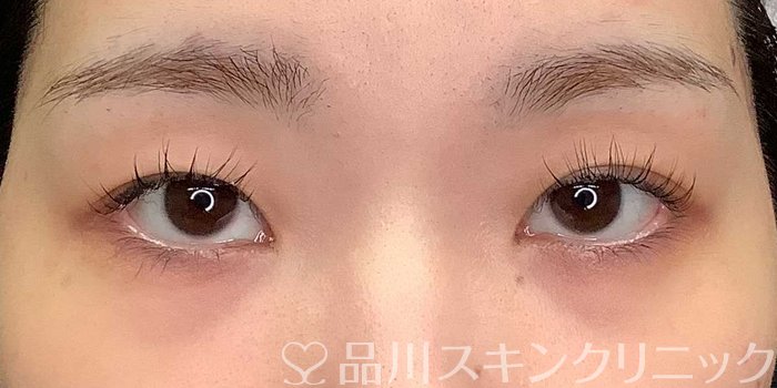症例NO.69704のBEFORE写真