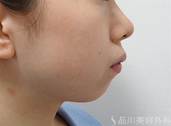 症例NO.52024のBEFORE写真
