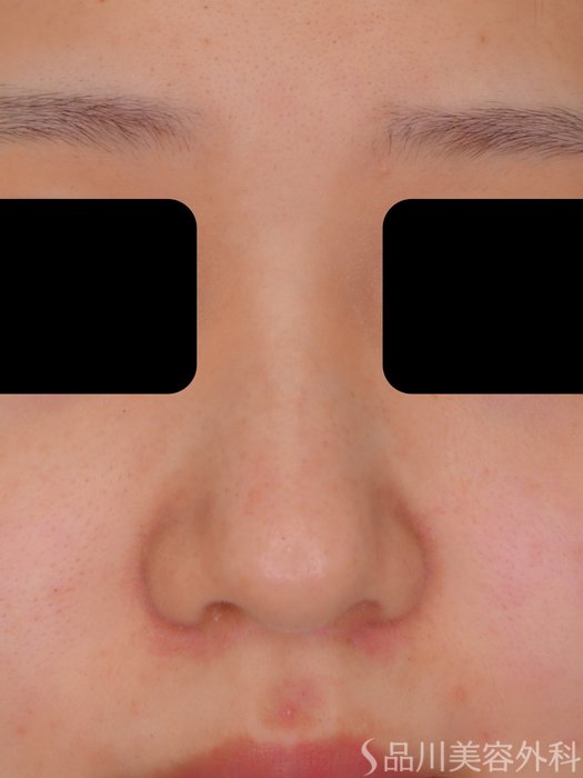 症例NO.73089のAFTER写真