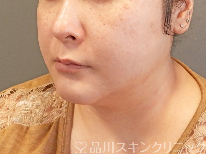 症例NO.66541のAFTER写真