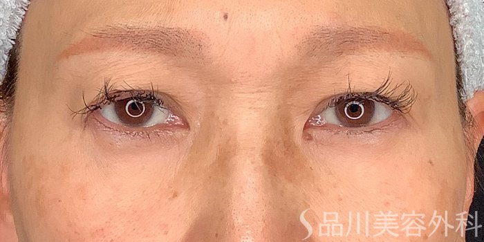 症例NO.71226のBEFORE写真