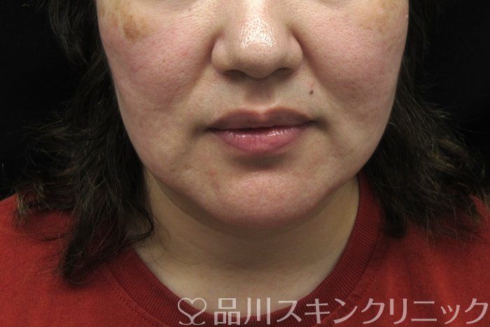 症例NO.74552のBEFORE写真
