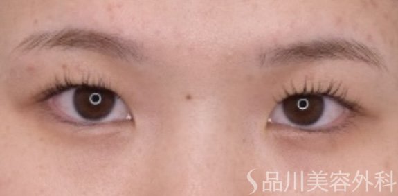 症例NO.67311のBEFORE写真