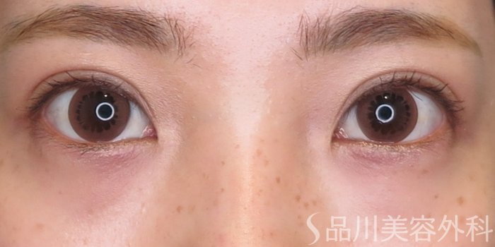 症例NO.71499のAFTER写真