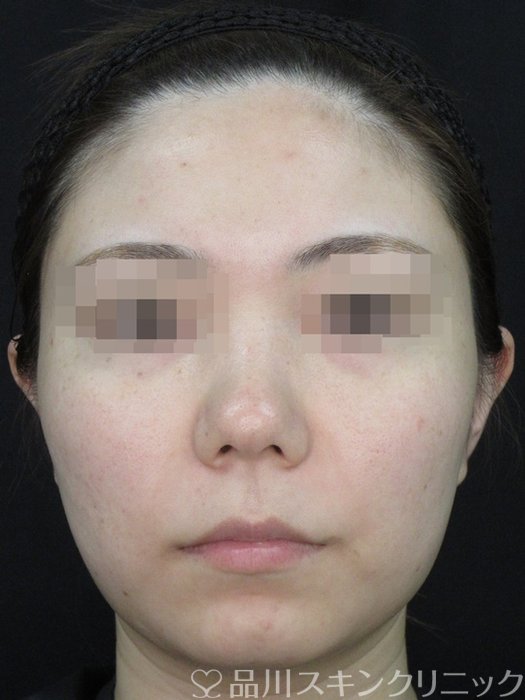 症例NO.73709のBEFORE写真