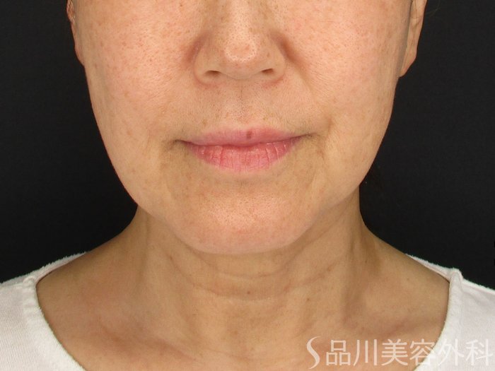症例NO.65151のBEFORE写真