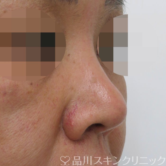 症例NO.70801のBEFORE写真