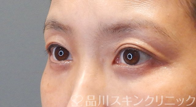 症例NO.75250のAFTER写真