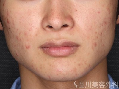 症例NO.74981のBEFORE写真
