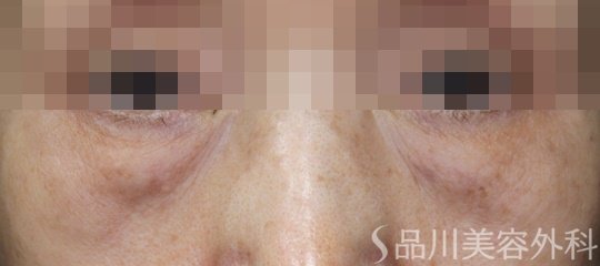症例NO.69625のBEFORE写真