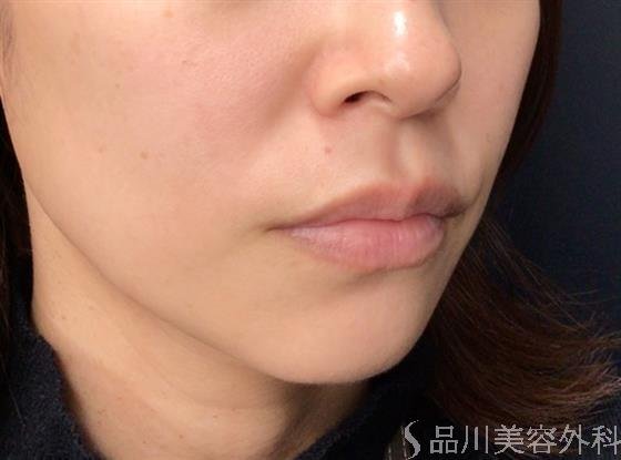 症例NO.59152のAFTER写真