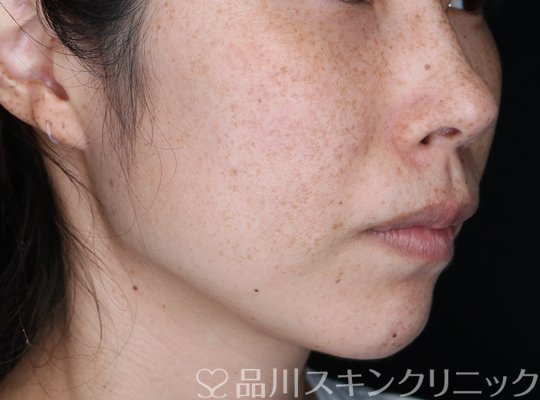 症例NO.64148のBEFORE写真