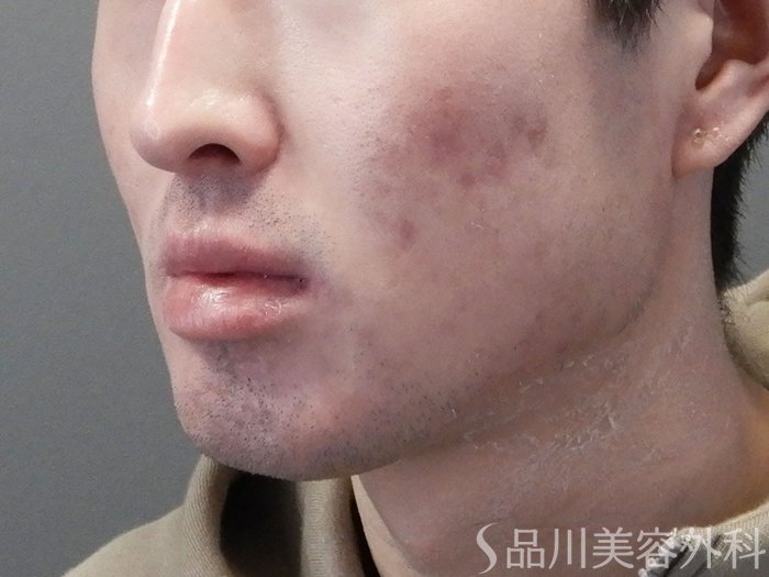 症例NO.73146のAFTER写真