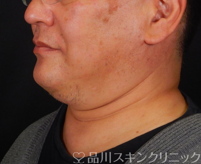 症例NO.65724のBEFORE写真